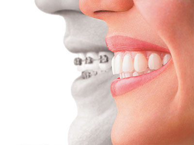 Schneider Family   Cosmetic Dentistry | Teeth Whitening, Invisalign reg  and Night Guards