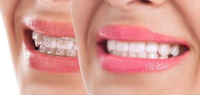 Schneider Family   Cosmetic Dentistry | Inlays  amp  Onlays, Periodontal Treatment and Dental Cleanings